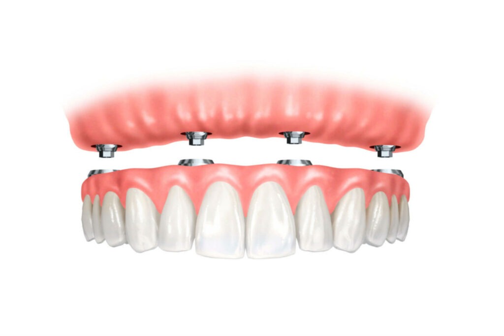 Implant Supported Dentures, Dental implants Richmond, Dental implants BC