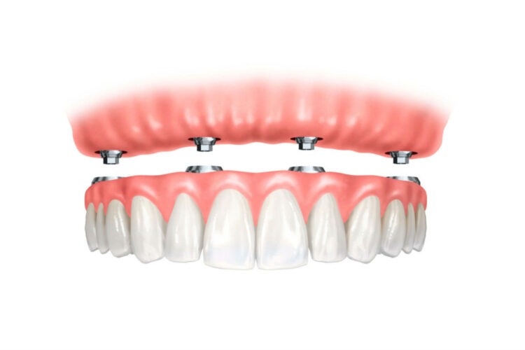 Implant Supported Dentures