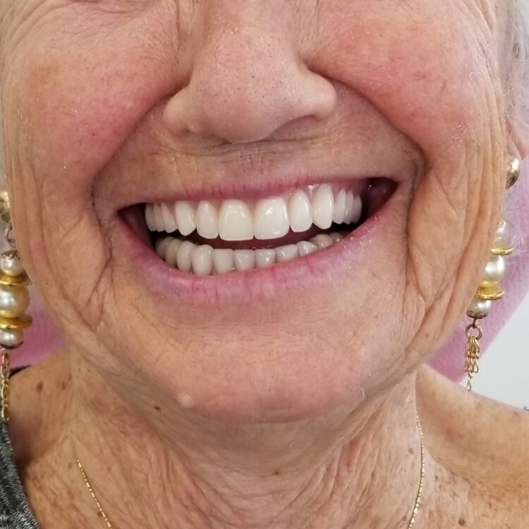 Full Dentures