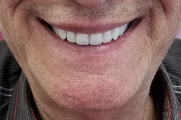 Denture Implant
