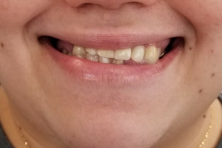 Crooked Smile - Before