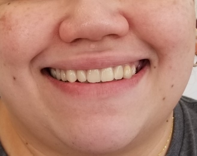 After denture treatment: straight, even smile
