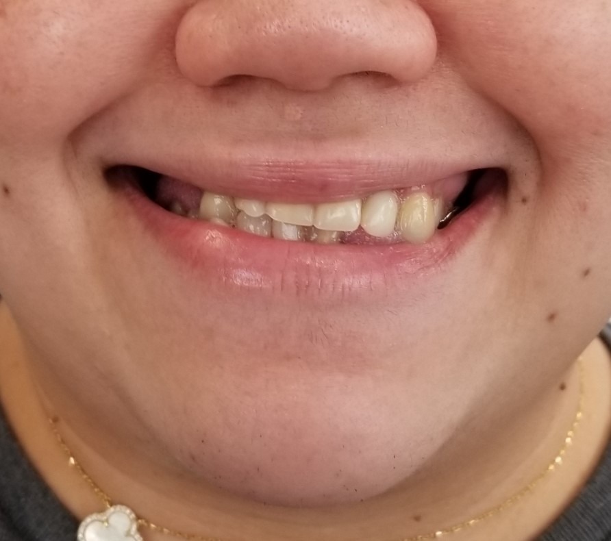 Before denture treatment: crooked, uneven smile